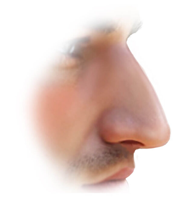 Zeichnung einer Langnase mit verlängertem Nasenrücken und abgesenkter Nasenspitze, die unproportional zum Gesicht wirkt, mit Hinweis auf die ästhetische und funktionelle Korrektur durch Dr. Krizmanic in Hamburg