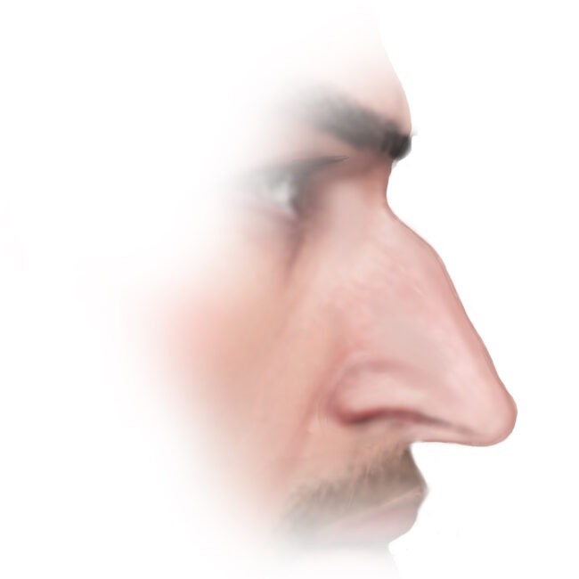 Illustration einer Spannungsnase zur Veranschaulichung der typischen Merkmale und Bereiche, die bei mit Nasenkorrektur korrigiert werden können